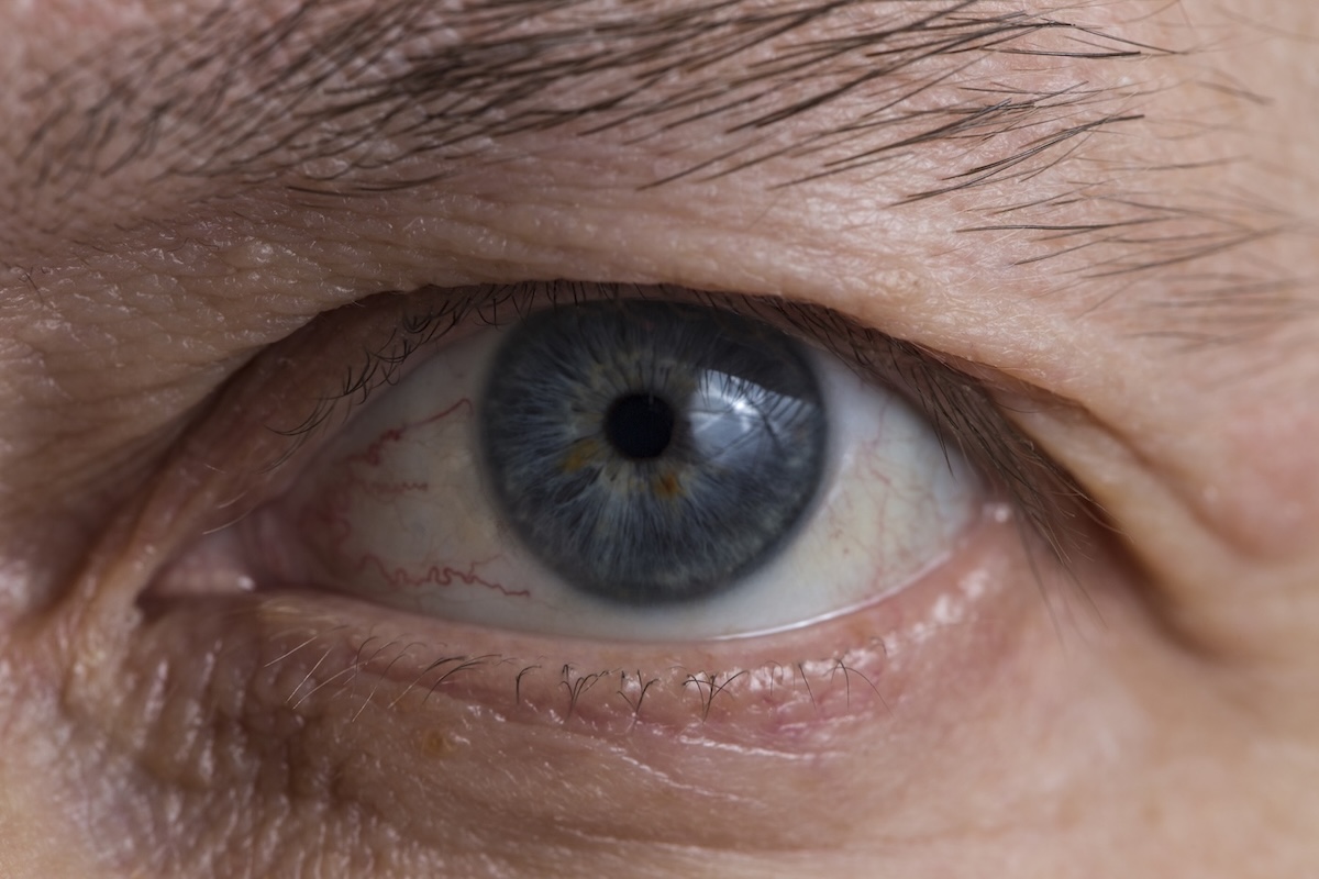 Image of dry eye after LASIK or cataract surgery.
